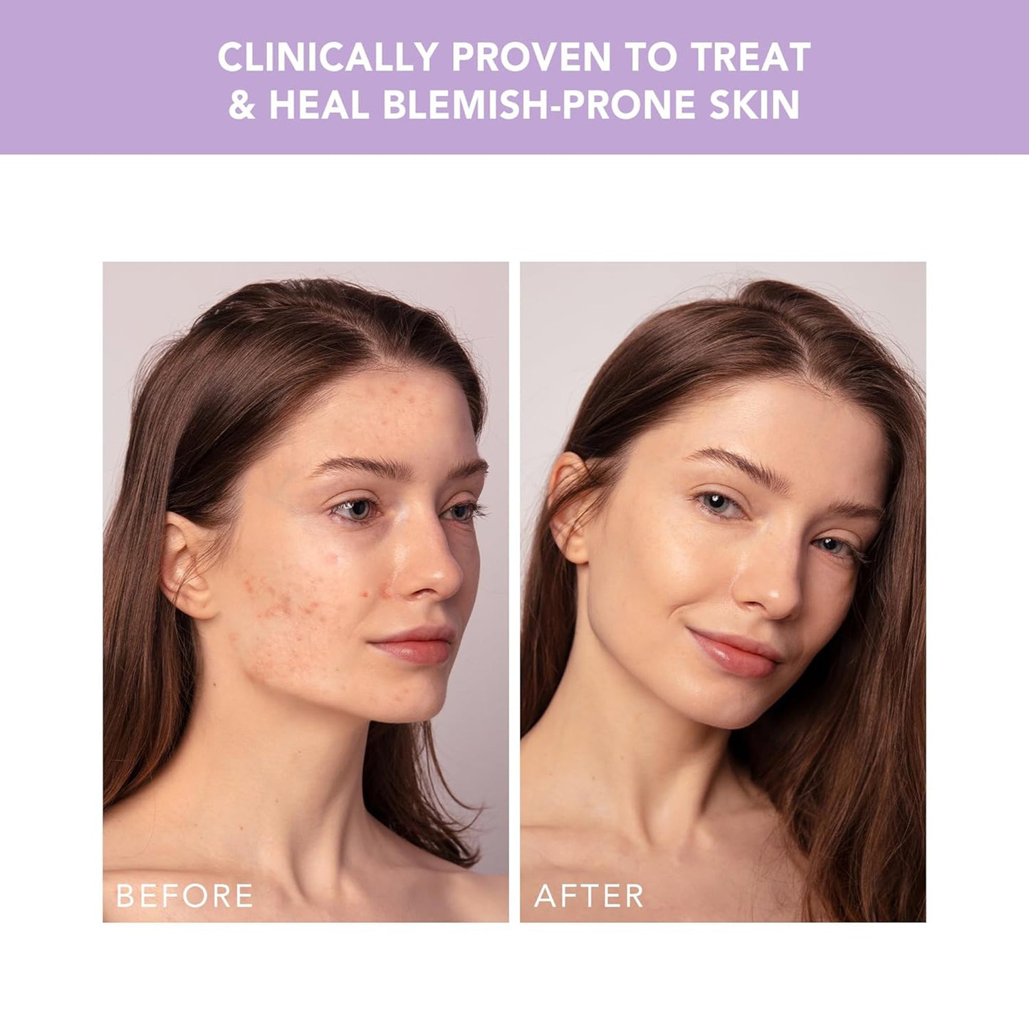 DEVICE, ACNE TRTMT ESPADA 2 PLUS W/BLEMISH SOL LAV