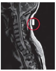 SKIN MARKER MRI 1.25" 40/BX