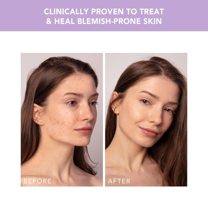DEVICE, ACNE TRTMT ESPADA 2 PLUS W/BLEMISH SOL LAV