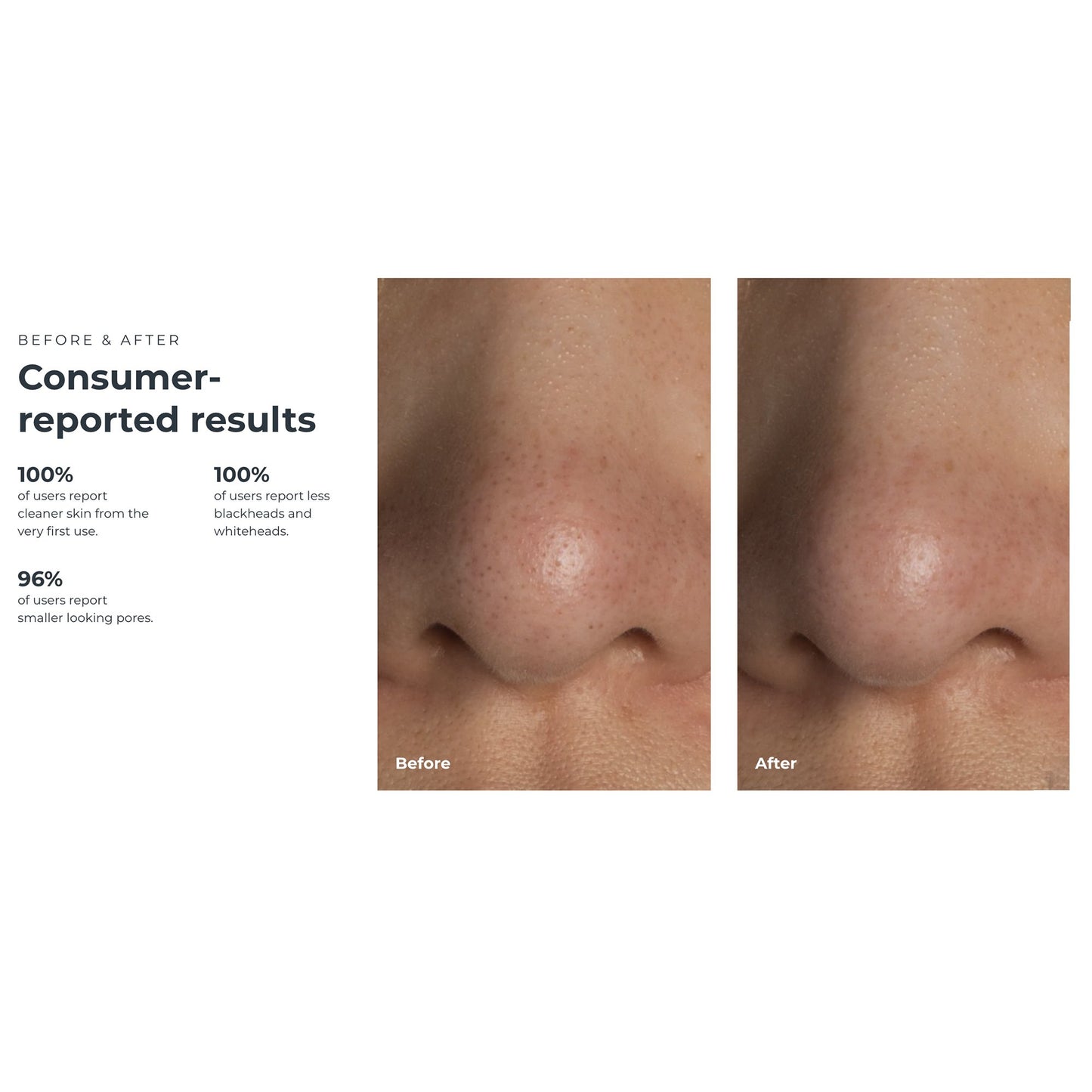 VACUUM, PORE BLACKHEAD REMOVERKIWI W/BLU LED LIGHT