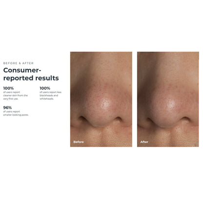 VACUUM, PORE BLACKHEAD REMOVERKIWI W/BLU LED LIGHT